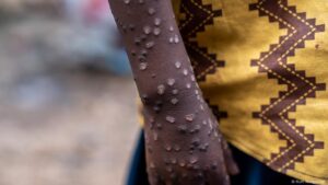Can the spread of mpox be curbed?